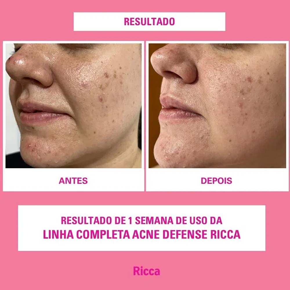 Sérum Facial Niacinamina Acne Defense Ricca 30ml