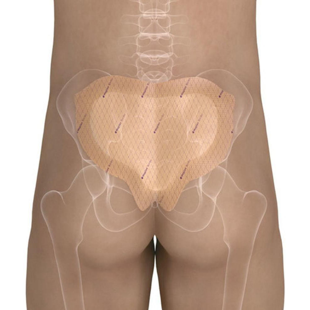 Curativo Sacral Mepilex Border Sacrum 22×25cm Molnlycke 1 Unidade
