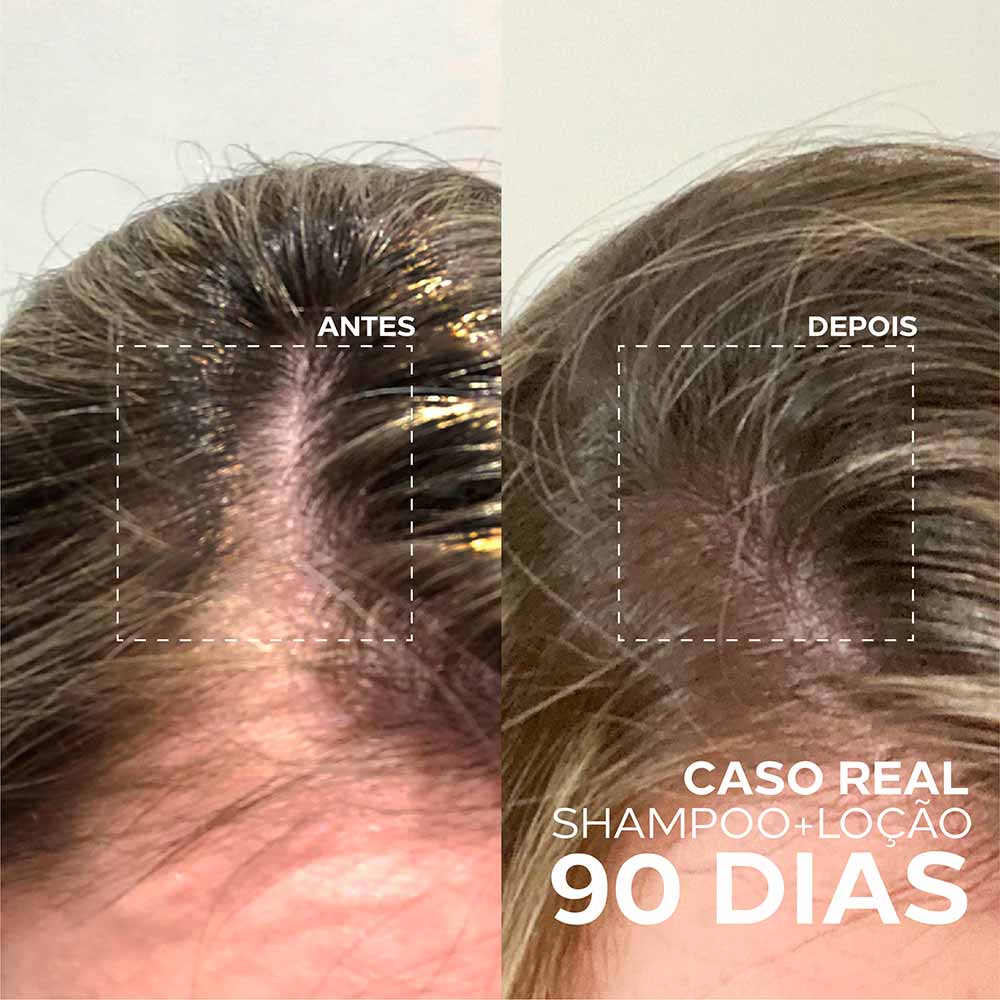 Loção Capilar Concentrada Amplexe Anti-Queda Tripla Ação Ada Tina 60ml