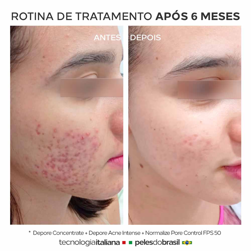 Sérum Facial Depore Acne Intense Ada Tina 30ml