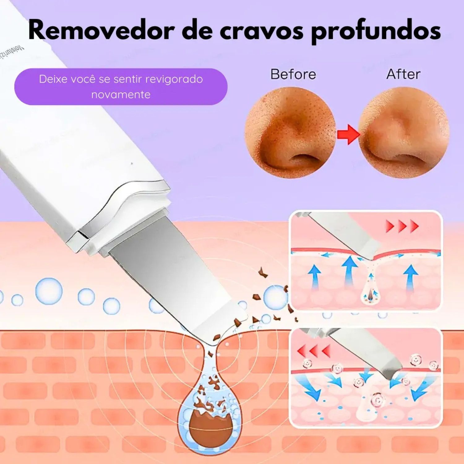 Aparelho Peeling Ultrasônico Com Ionização Tira Cravos 2 Em 1